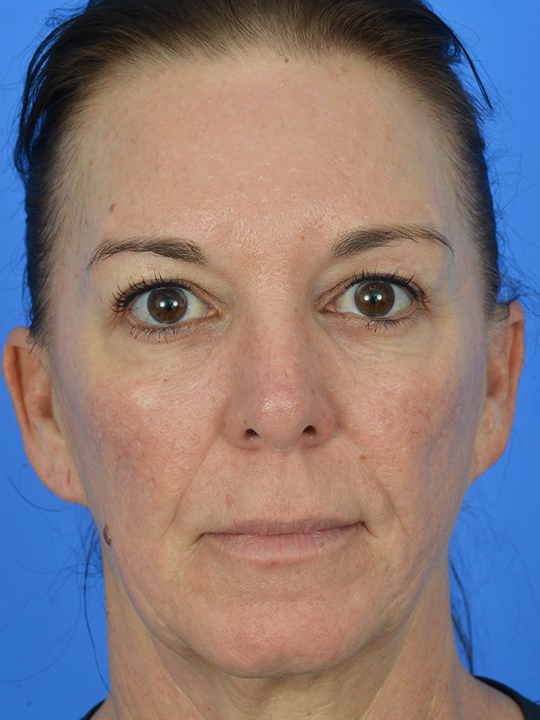 Case--7663 | Before Facial Fat Transfer