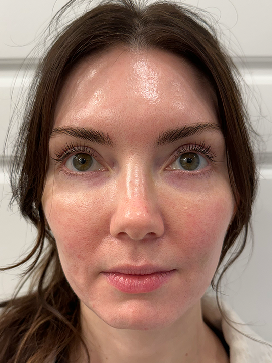 Case--4328 | After FaceTite™