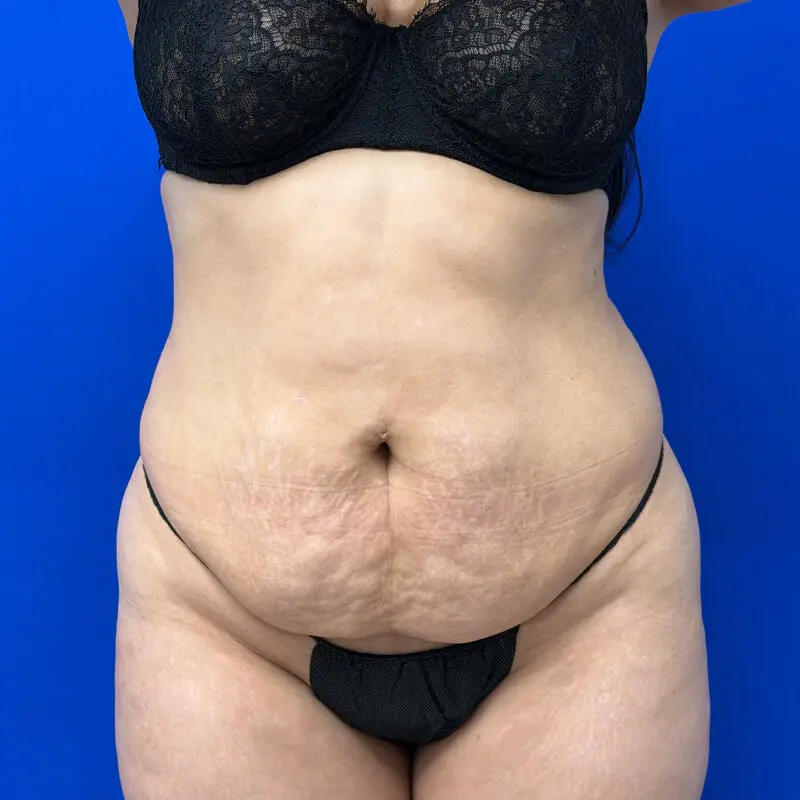 Patient Before & After Photo
