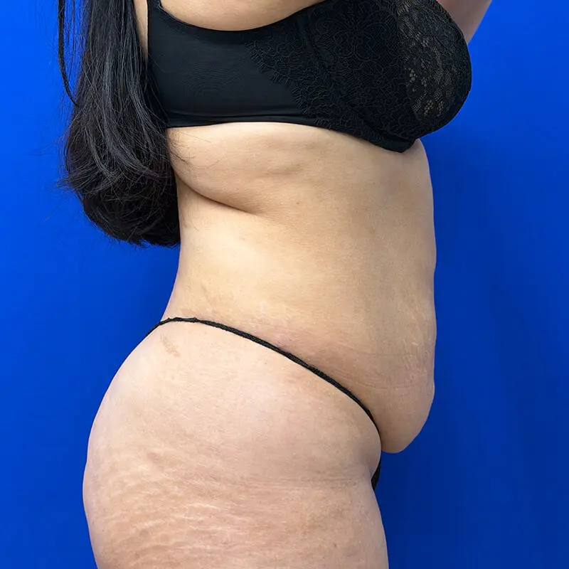 Patient Before & After Photo