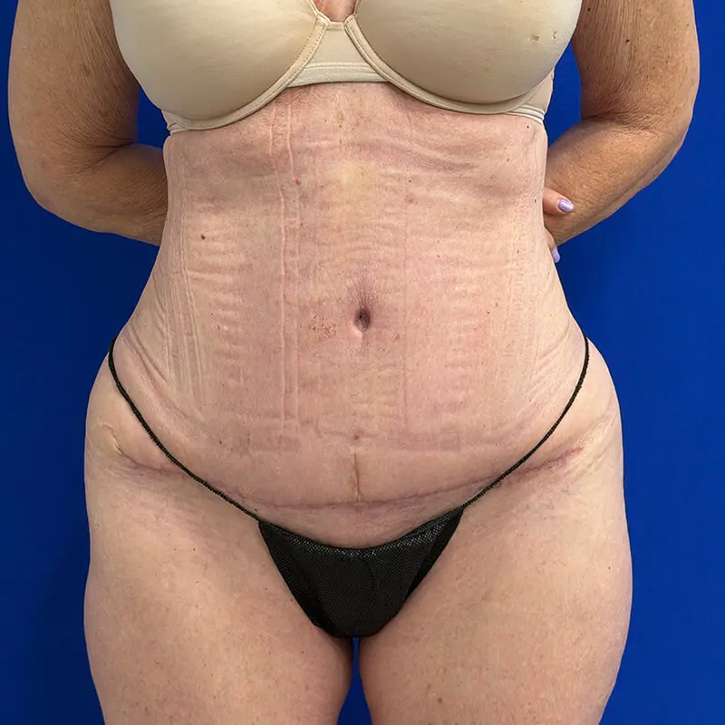Case--1787 | After Liposuction
