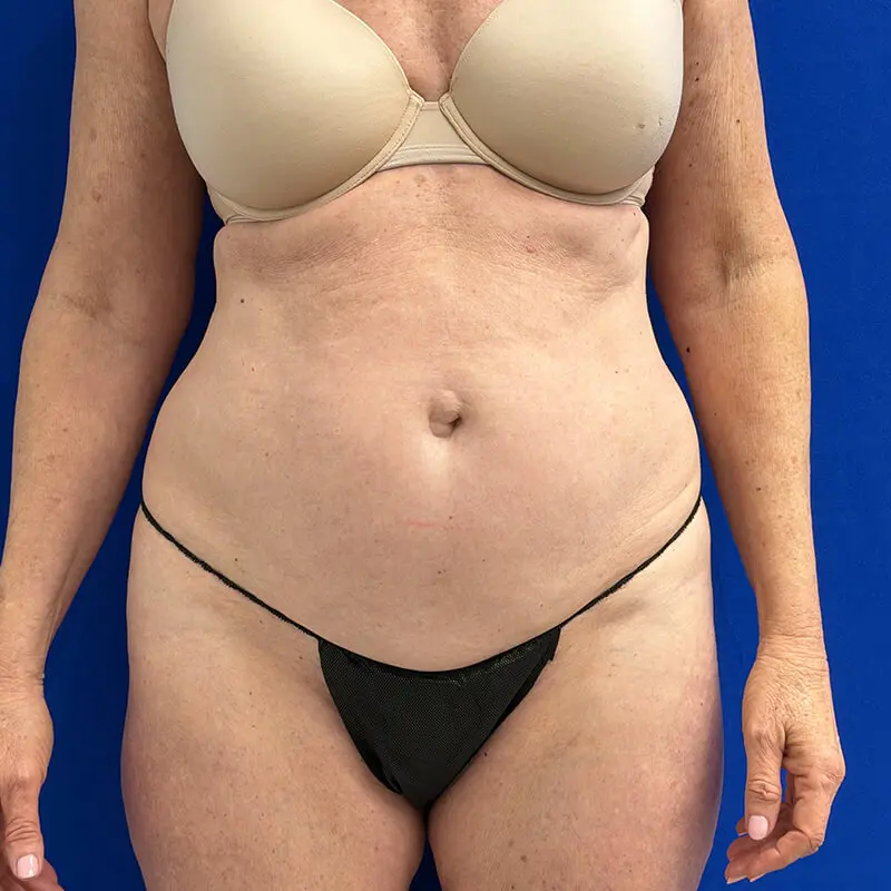 Case--1787 | Before Liposuction