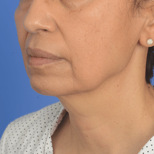93556 Lower face rejuvenation oblique view pre op