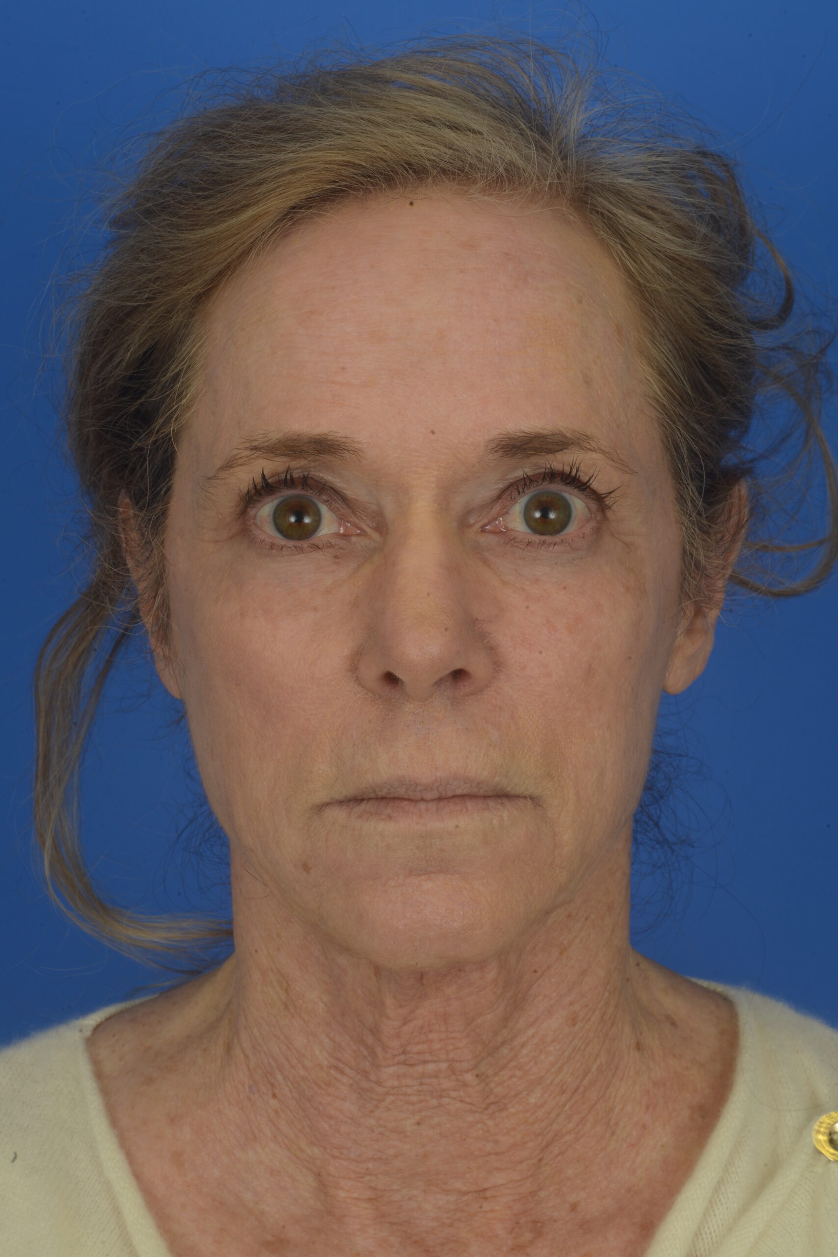 Full-face--fully-ablative-CO2-laser-procedure-in-addition-to-a-Facelift | Before Eyelid Surgery
